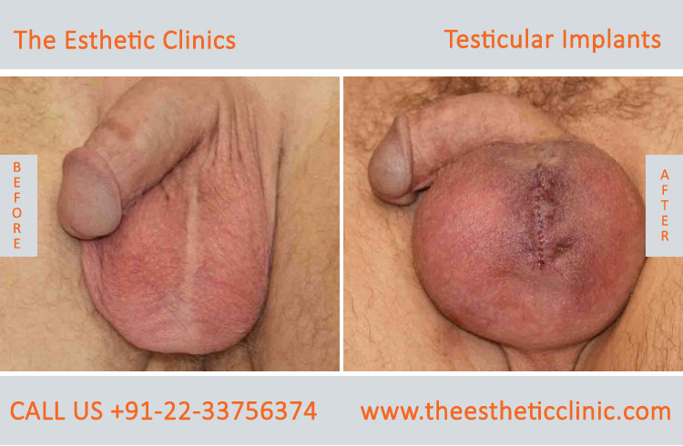 Testicular Implant surgery before after photos in mumbai india (4)
